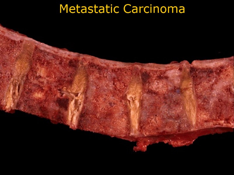 Metastatic Carcinoma